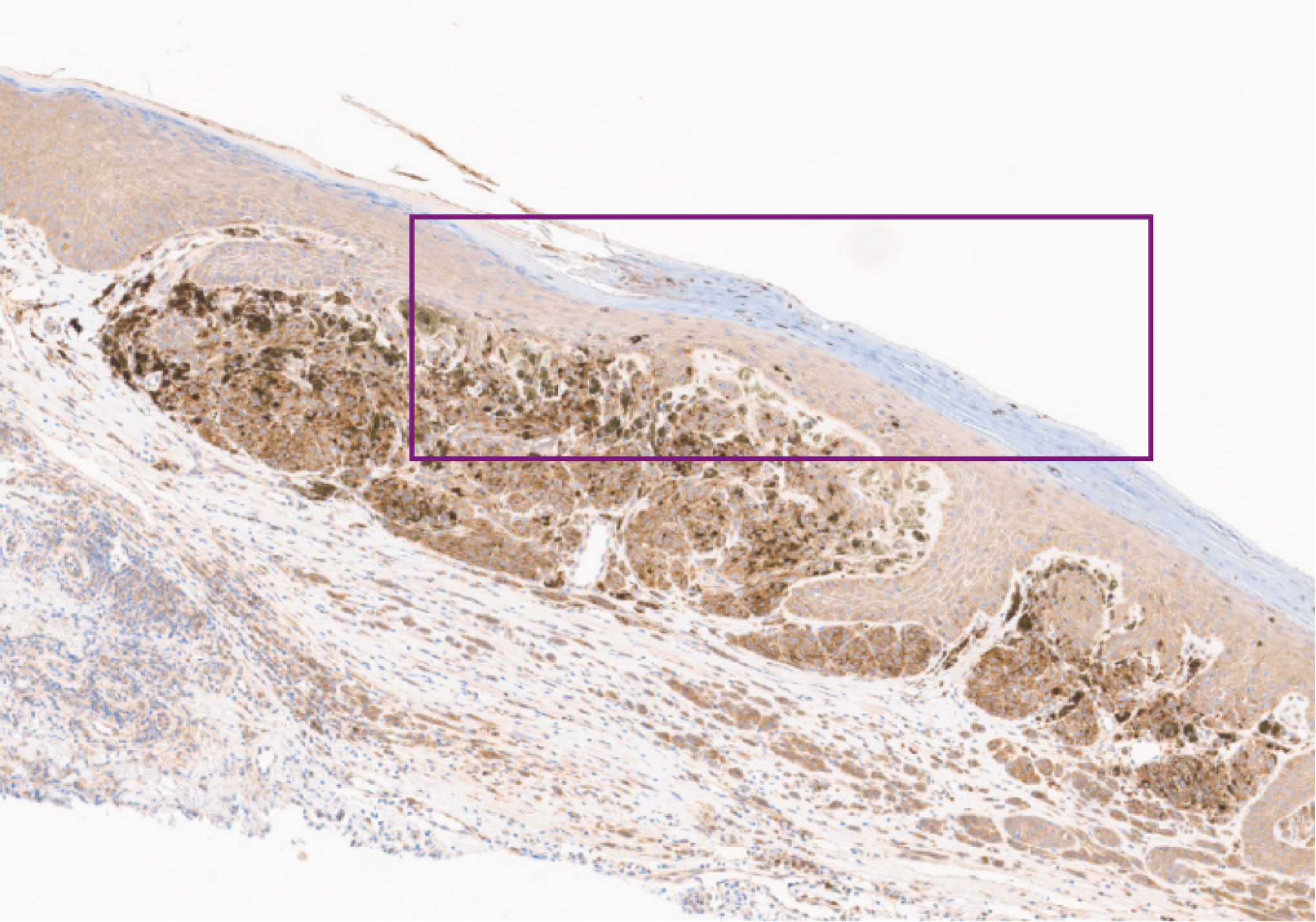 Histopathology slide – AMBRA1 lost (4x magnification)