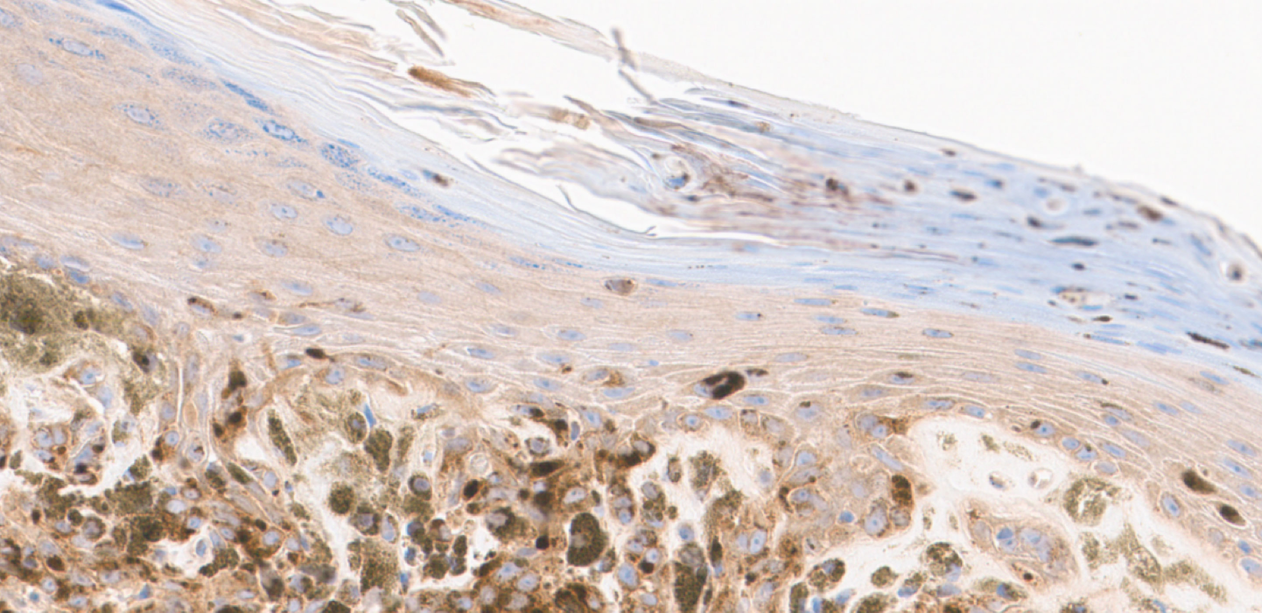 Histopathology slide – AMBRA1 lost (40x magnification)